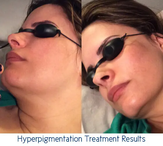 DualMax IPL - Image 2