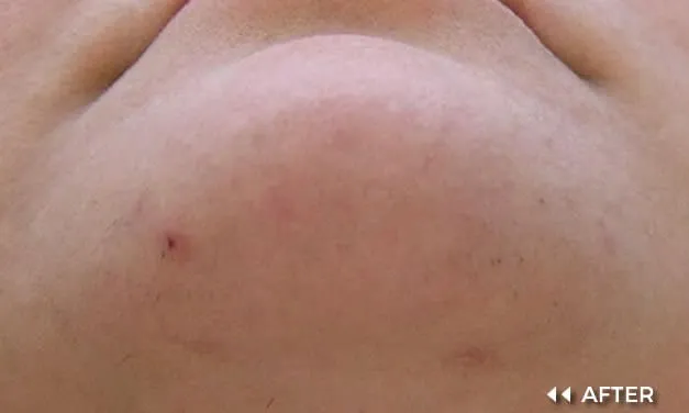 MULTI-LASE IPL - Image 5