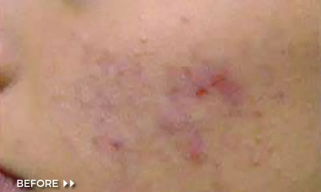 MULTI-LASE IPL - Image 2