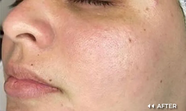 MULTI-LASE IPL - Image 3