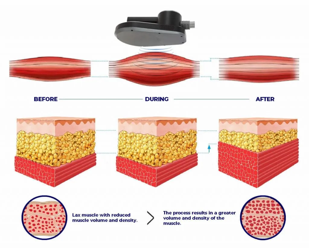 Hi-TONE XL: Advanced Muscle Toning and building system, EMS+EFWT - Image 7